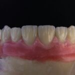 un gros plan d'une dent recouverte de pâte de gomme